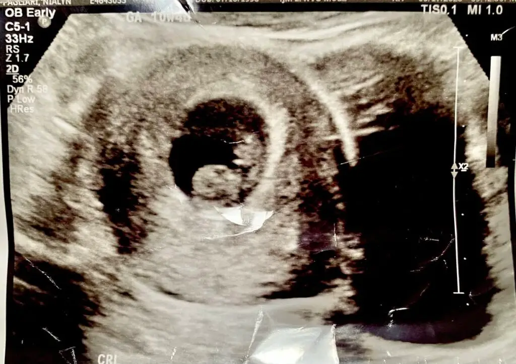 Ultrasound of Naphtali David Pagliari at 10 weeks and 4 days